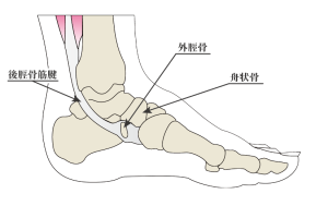 外脛骨障害