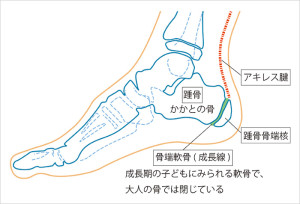 シーバー病